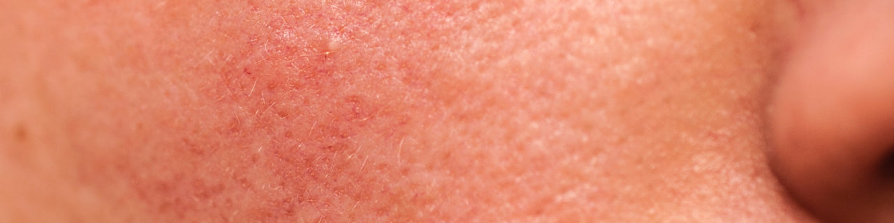 How To Know If The Skin Barrier Is Damaged