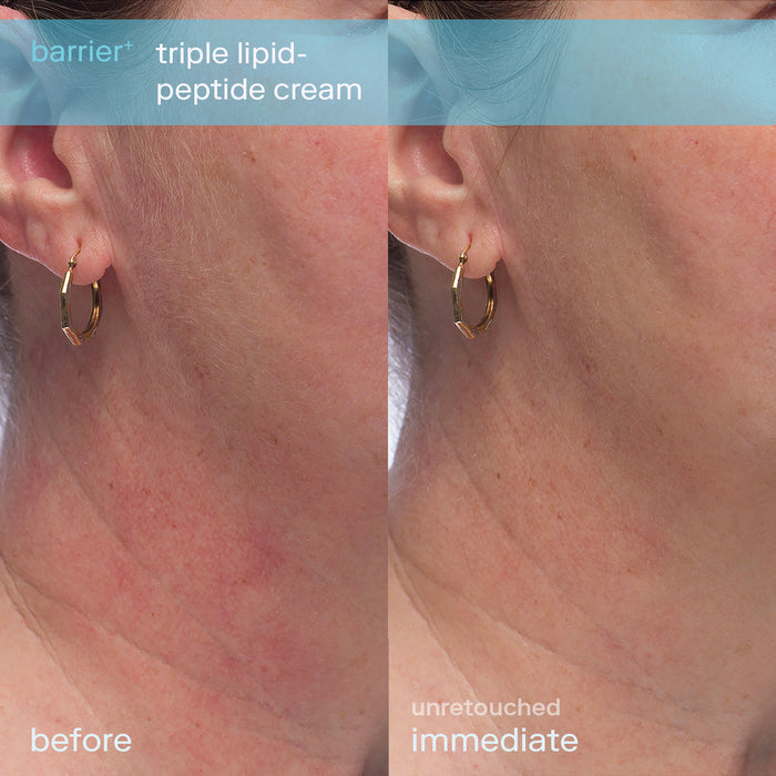 Triple Lipid Peptide Cream Before and After