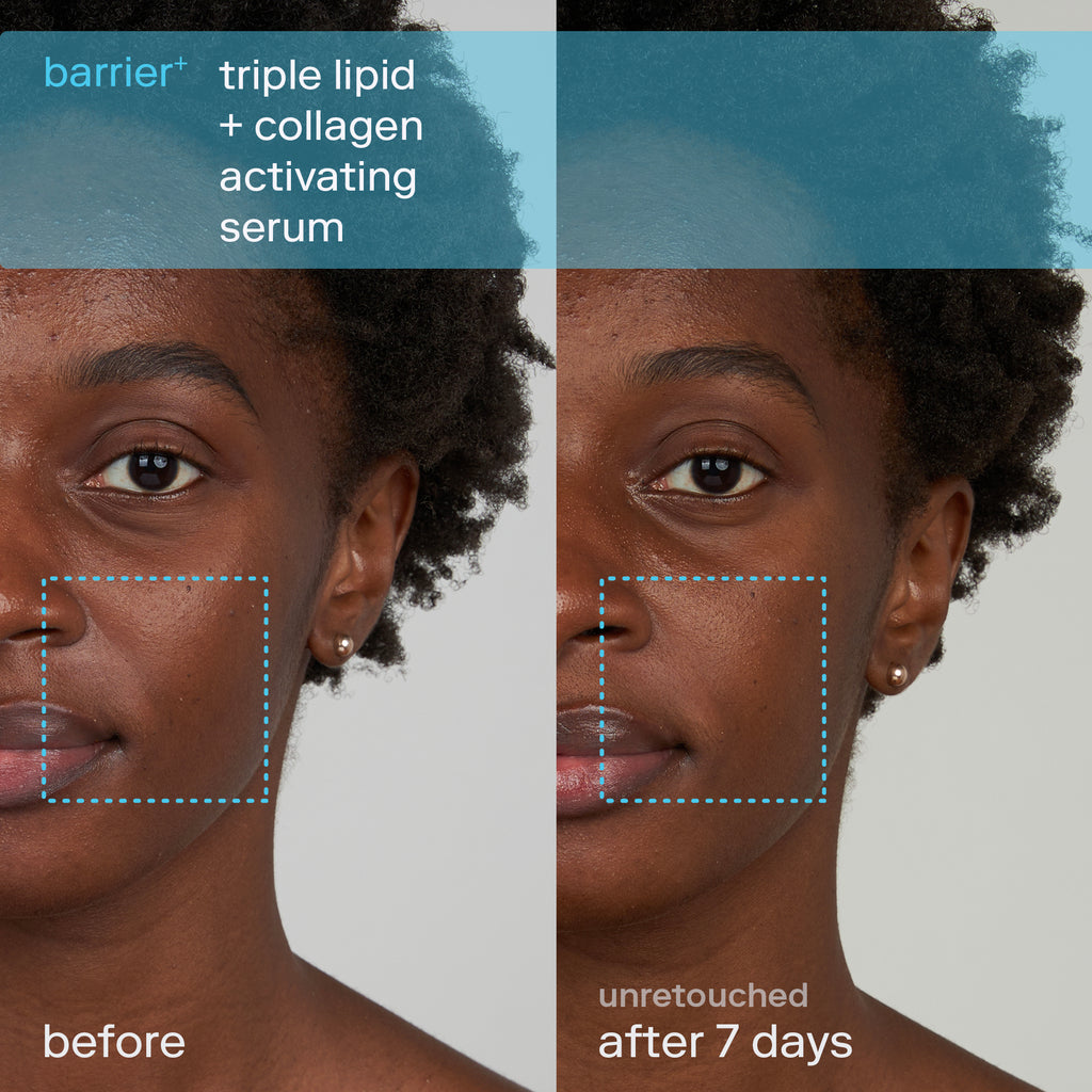 Triple Lipid Collagen Activating Serum Before and After