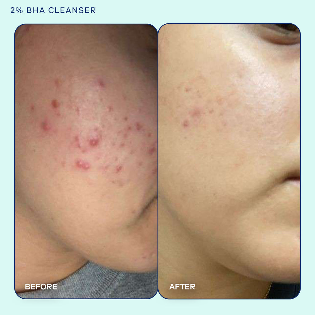 Skinfix 2% BHA Cleanser before and after results