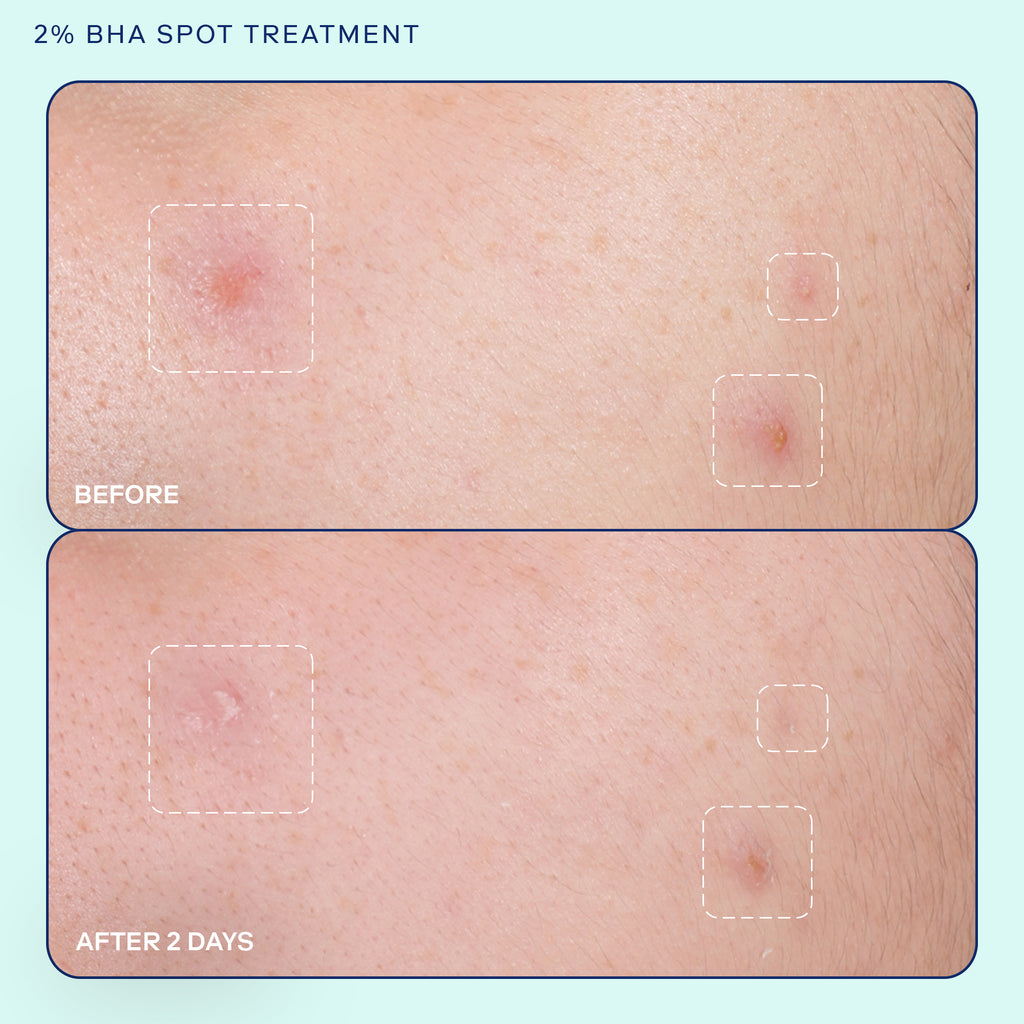 2% BHA Spot Treatment before and after results