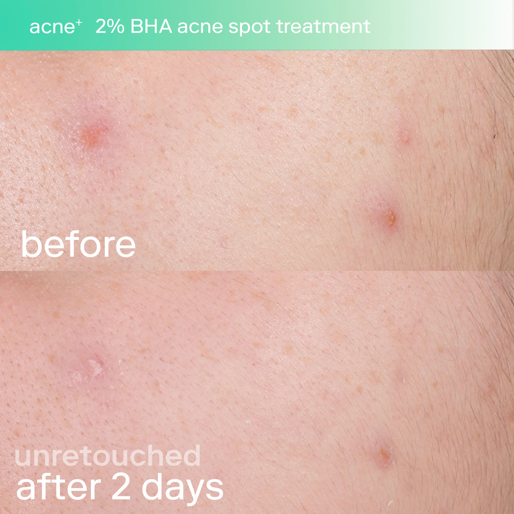 Acne+ 2% BHA Spot Treatment before and after