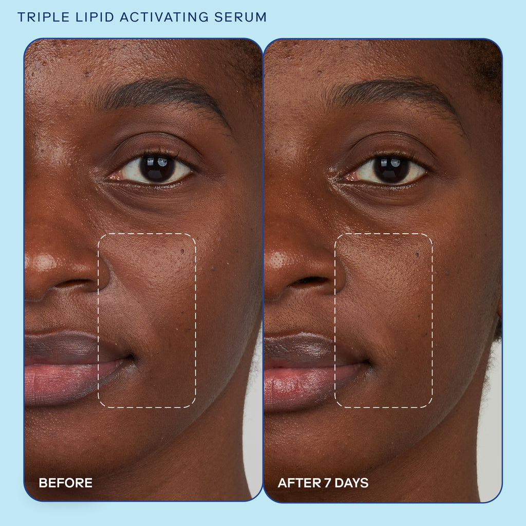 Skinfix Barrier Triple Lipid Activating Serum Refill Before and After results showing plumper smile lines