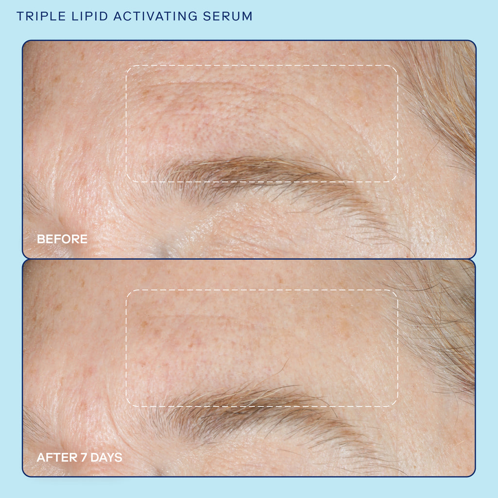 Skinfix Barrier Triple Lipid Activating Serum Refill Before and After Results showing diminished fine lines