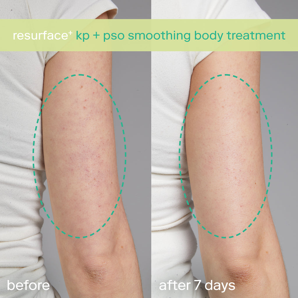 KP + PsO Smoothing Body Treatment before and after keratosis pilaris