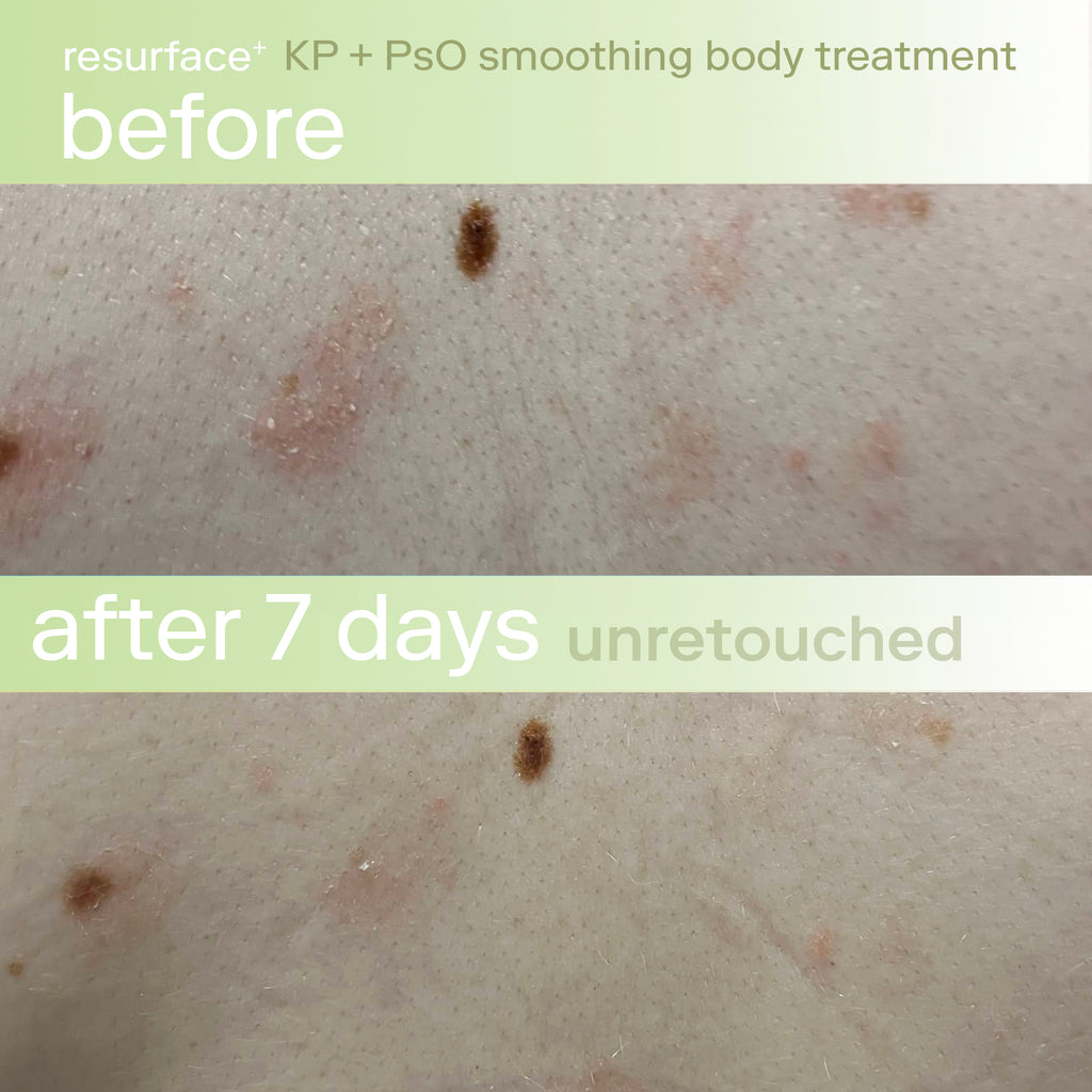 KP + PsO Smoothing Body Treatment before and after psoriasis
