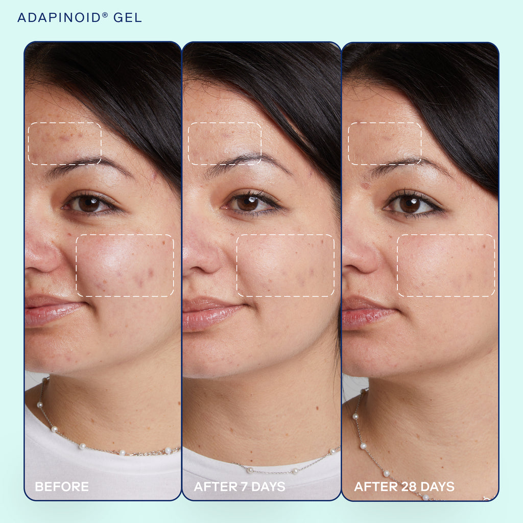 Skinfix Adapioid Gel before and after results