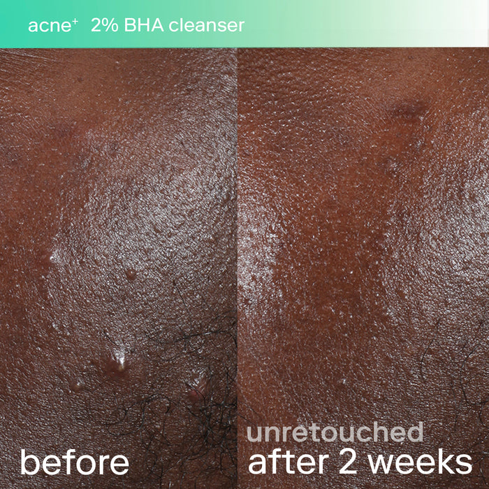 acne+ 2% bha cleanser set before and after