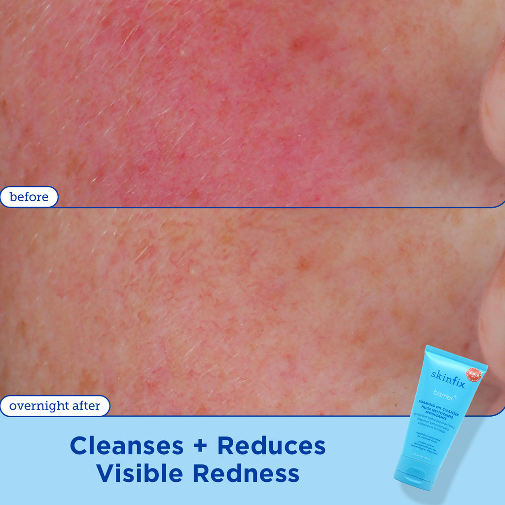 Skin Barrier Repair Products For Damaged Skin | Skinfix – Skinfix USA