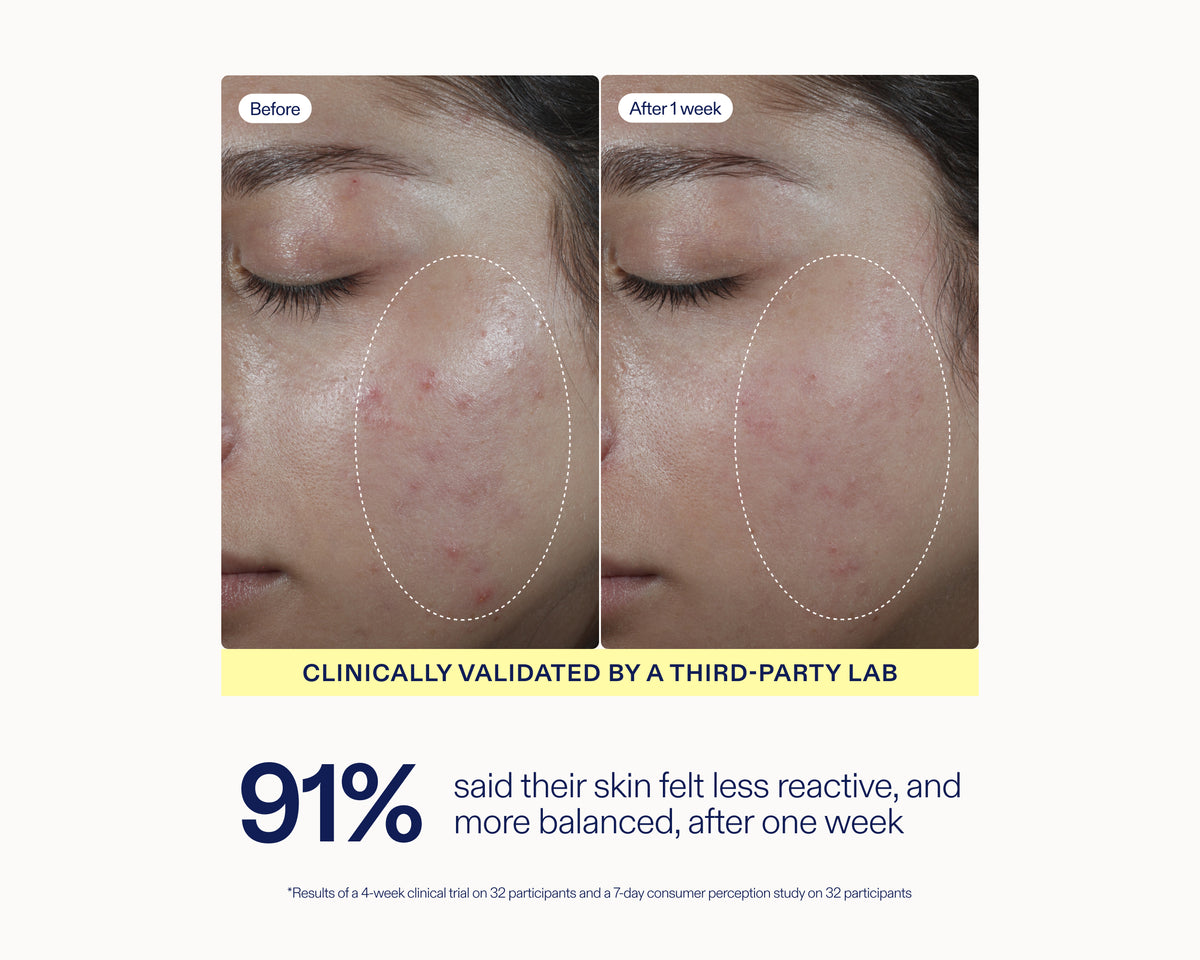 Before-and-after skin comparison showing a person's eye area with acne and redness, labeled 'Before' and 'After 1 week,' with text stating 'Clinically validated by a third-party lab' and '91% said their skin felt less reactive, and more balanced, after one week.'.