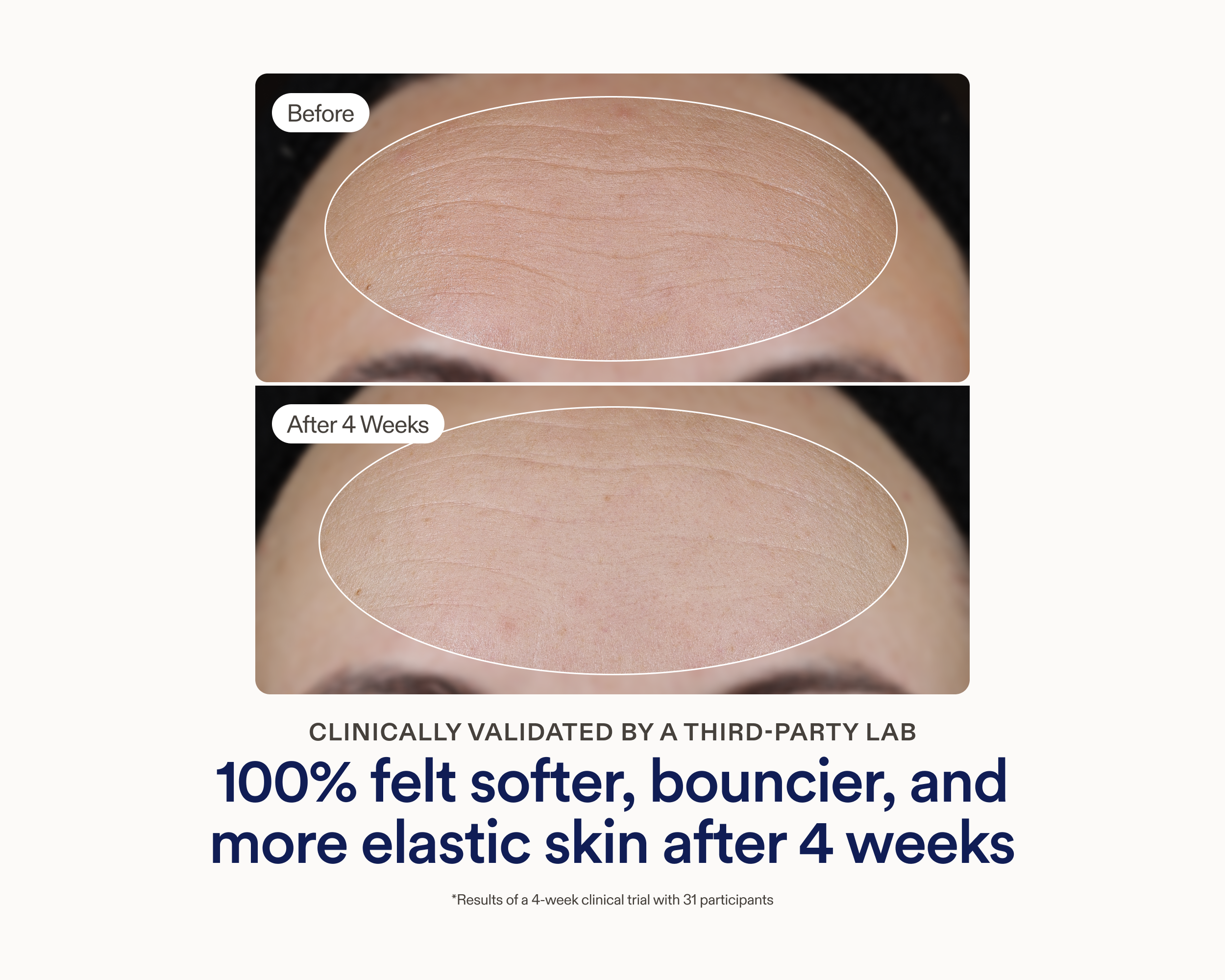 Stacked before and after clinical photos showing visibly smoother, more elastic skin on the forehead after 4 weeks of using Skinfix Ceramide Prime Whipped Cream, with text reading: Clinically validated by a third-party lab — 100% felt softer, bouncier, and more elastic skin after 4 weeks.