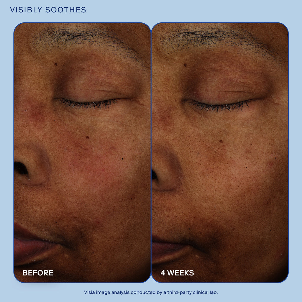 Image showing before and after results of Skinfix Exo + Ectoin Intensive Repair Baume for 4 weeks. Before results show redness, unevenness, deflated skin. After results show even, brighter, plumper skin.