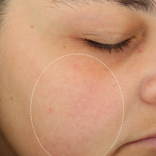 Close-up of the same person’s cheek after cleansing, highlighted by a dotted circle.