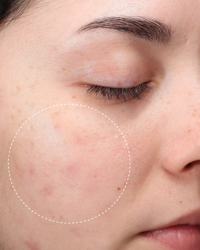 Close-up of same cheek with reduced redness and blemishes circled, after using Hypochlorous Daily Mist.