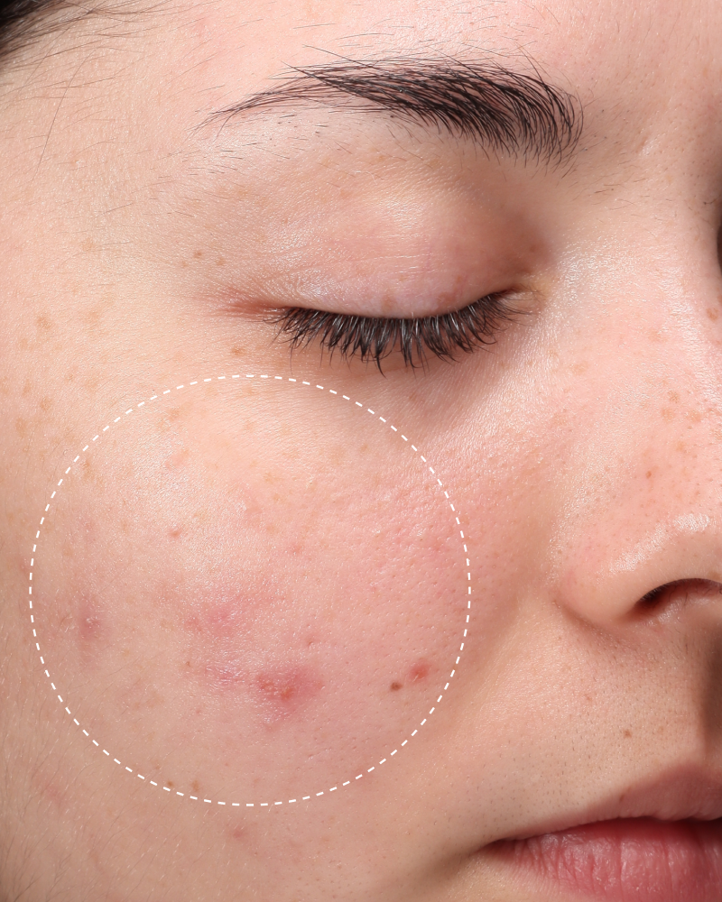 Close-up of cheek with redness and blemishes circled, before using Hypochlorous Daily Mist.