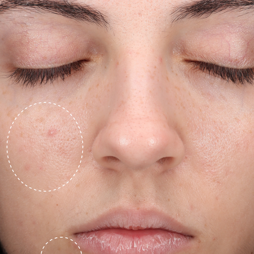 Close-up of same cheek and lip area with faded blemishes circled, after using Hypochlorous Daily Mist.