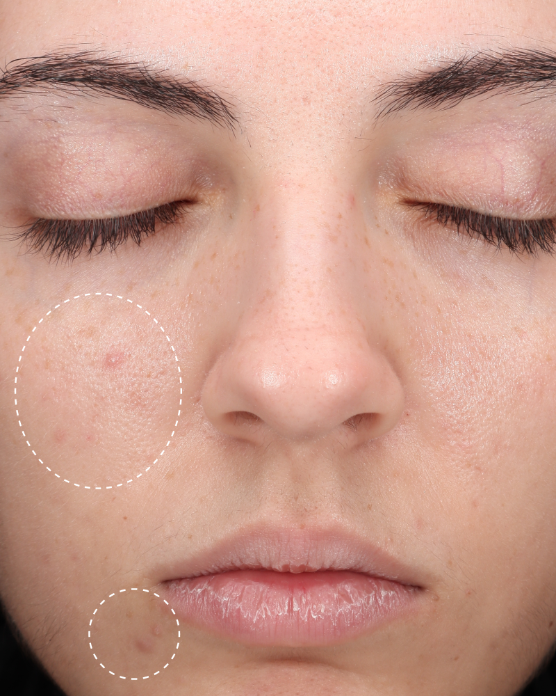 Close-up of same cheek and lip area with faded blemishes circled, after using Hypochlorous Daily Mist.