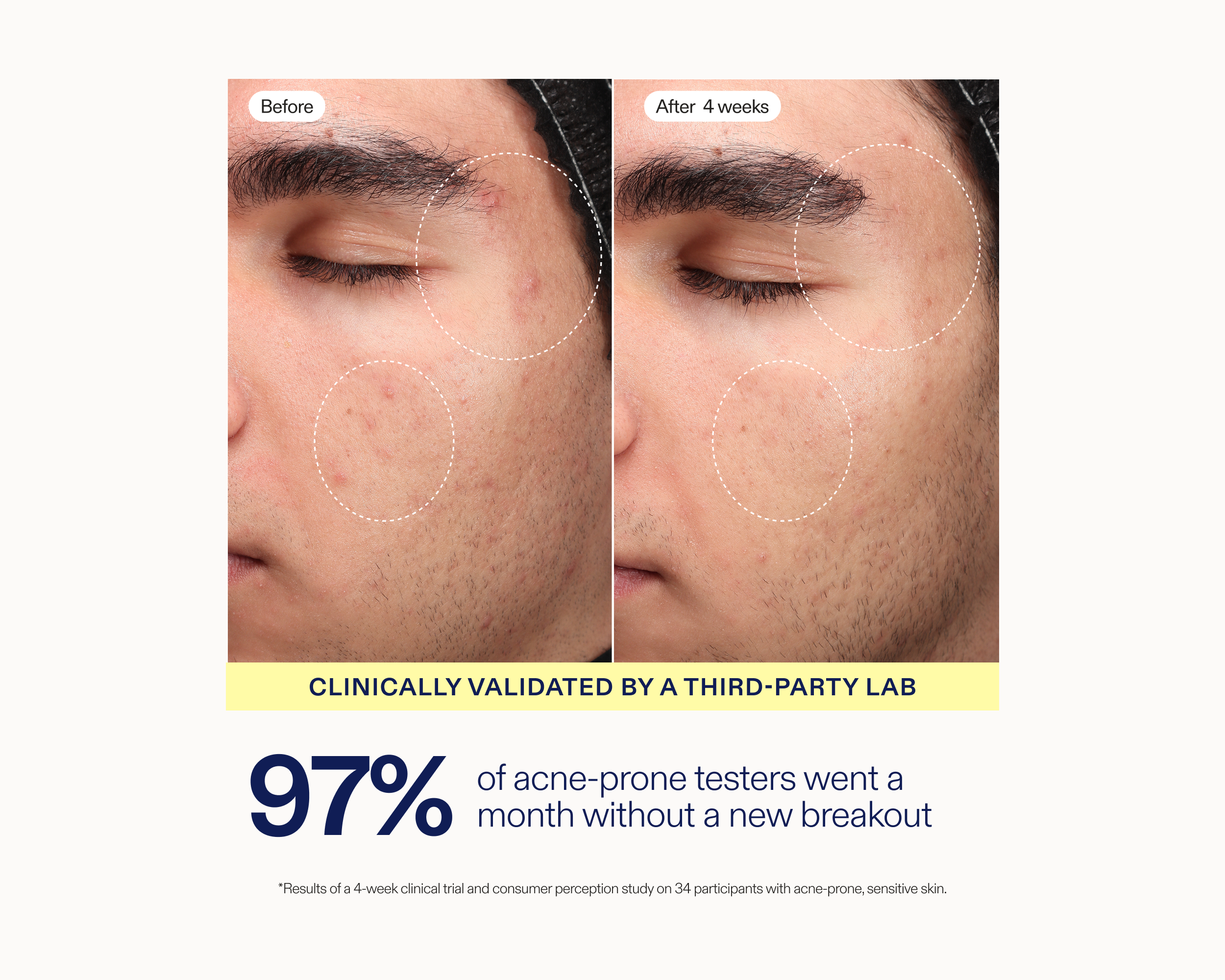 Before-and-after acne treatment results comparison showing a man's face with breakouts on the forehead, eyebrows, cheeks, and chin, labeled 'Before' and 'After 4 weeks'. Below the comparison is a yellow banner reading 'Clinically validated by a third-party lab' and large text stating '97% of acne-prone testers went a month without a new breakout'.