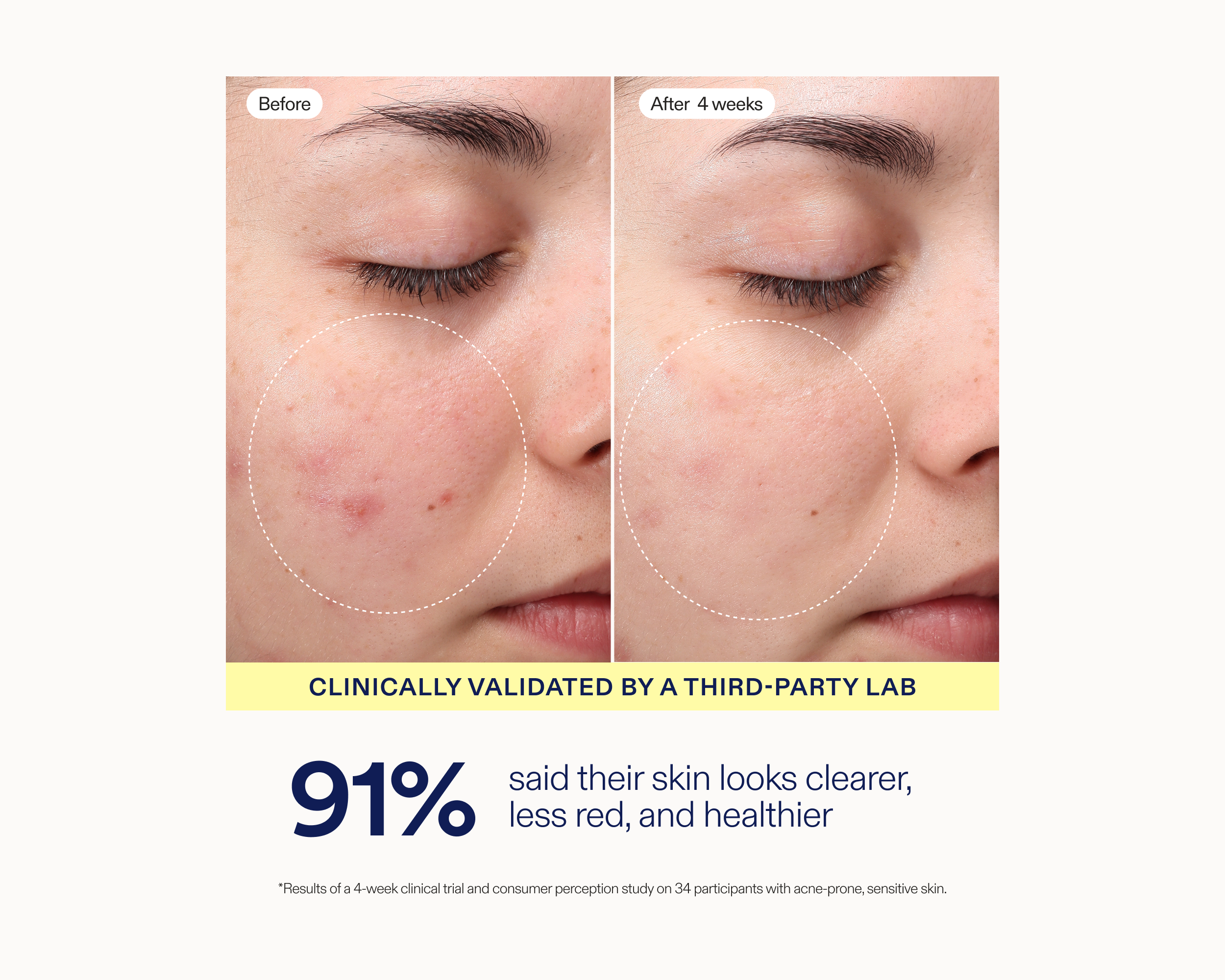 Before-and-after skin comparison showing a person's closed eye with red blemishes in the 'Before' panel and clearer skin in the 'After 4 weeks' panel. Text below states 'Clinically validated by a third-party lab' and '91% said their skin looks clearer, less red, and healthier.