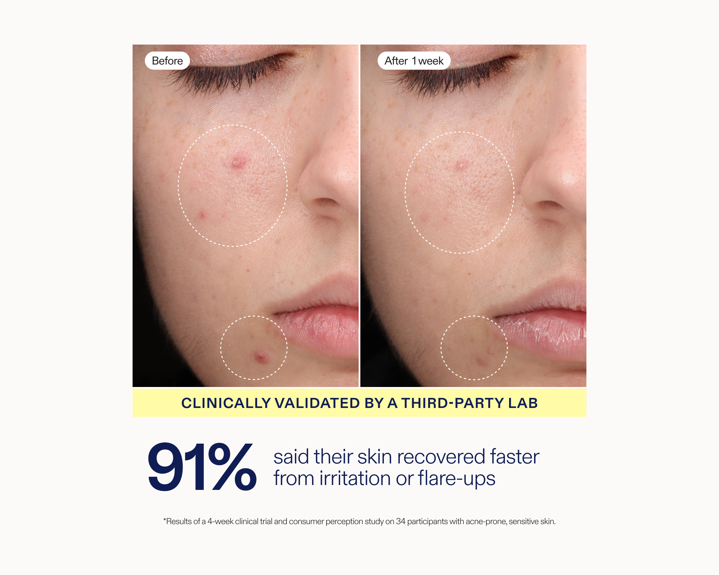 Before-and-after skin comparison showing a person's cheek and mouth area, with dotted circles highlighting acne or redness. Text below reads 'Clinically Validated by a Third-Party Lab' and '91% said their skin recovered faster from irritation or flare-ups.