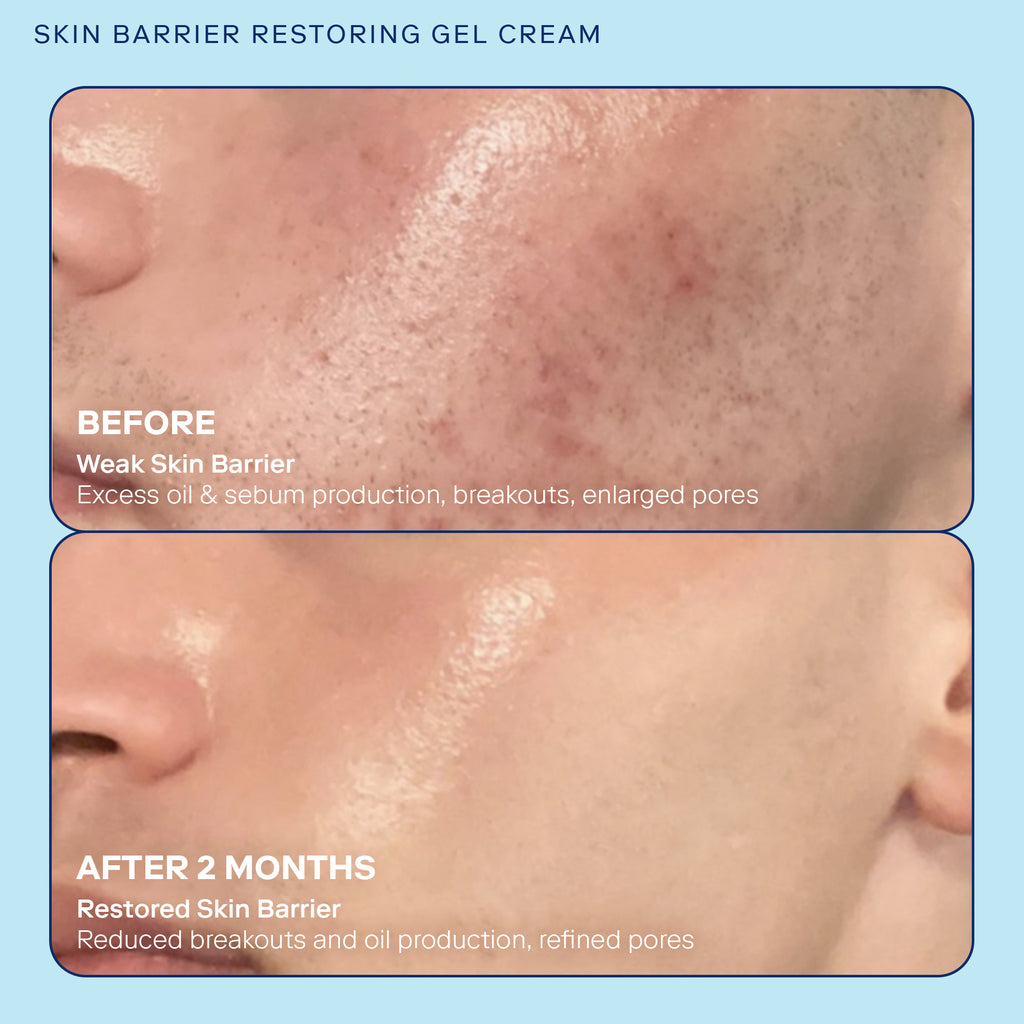 Skin Barrier Restoring Gel Cream before and after image