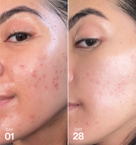 Side-by-side close-up of a person’s cheek showing skin appearance on Day 01 and Day 28, with visible changes in redness and texture.