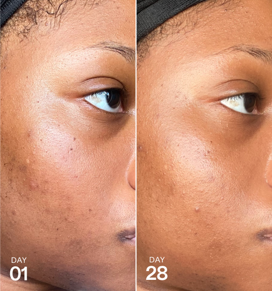 Side-by-side close-up of a person’s cheek on Day 01 and Day 28, showing changes in the appearance of dark spots and uneven skin tone.