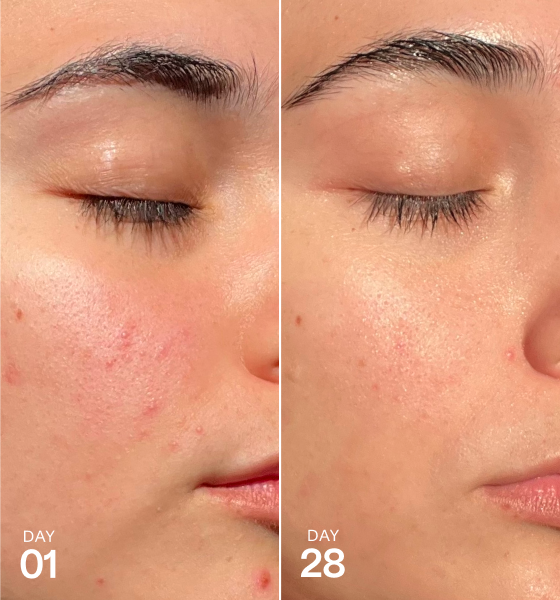 Side-by-side close-up of a person’s cheek showing skin appearance on Day 01 and Day 28, highlighting changes in texture and visible discoloration.