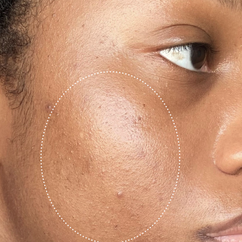 Close-up of a person's eye and forehead with visibly improved skin texture.