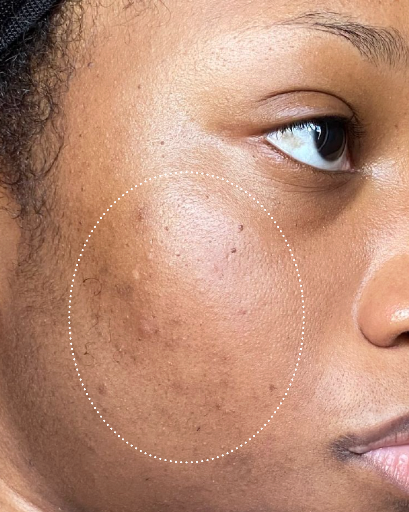 Close-up of a person’s cheek with visible dark spots and uneven skin tone highlighted by a dotted circle.