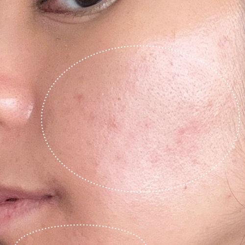 Close-up of a person's face with visibly less blemishes on the skin and brighter skin.