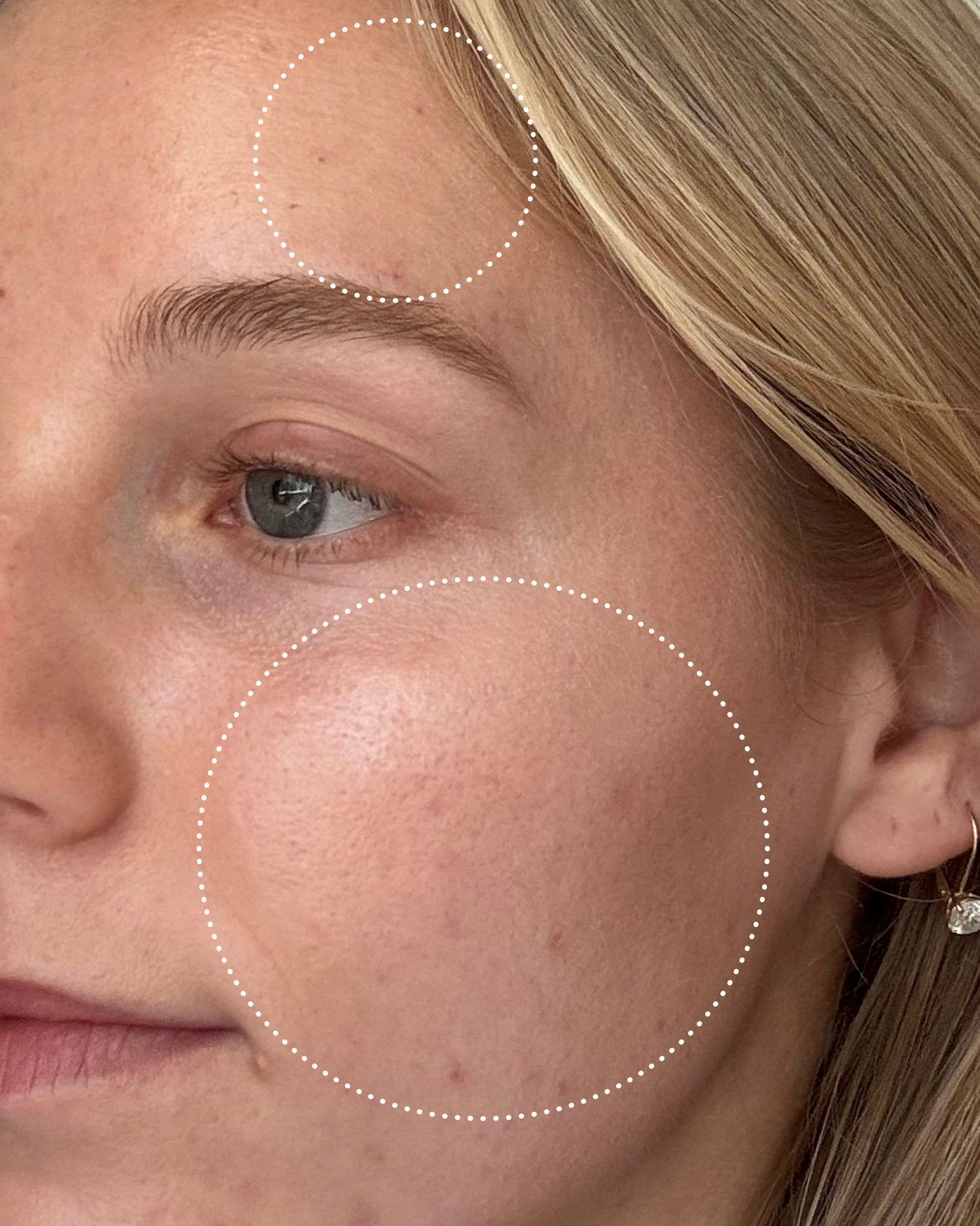 Close-up of a person's face with circles highlighting skin texture and dark spots