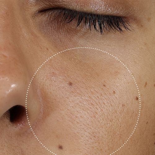 Clinical after photo showing visibly smoother, refined skin texture on the cheek following use of Skinfix Ceramide Prime Whipped Cream, with a dotted circle highlighting the treatment area.