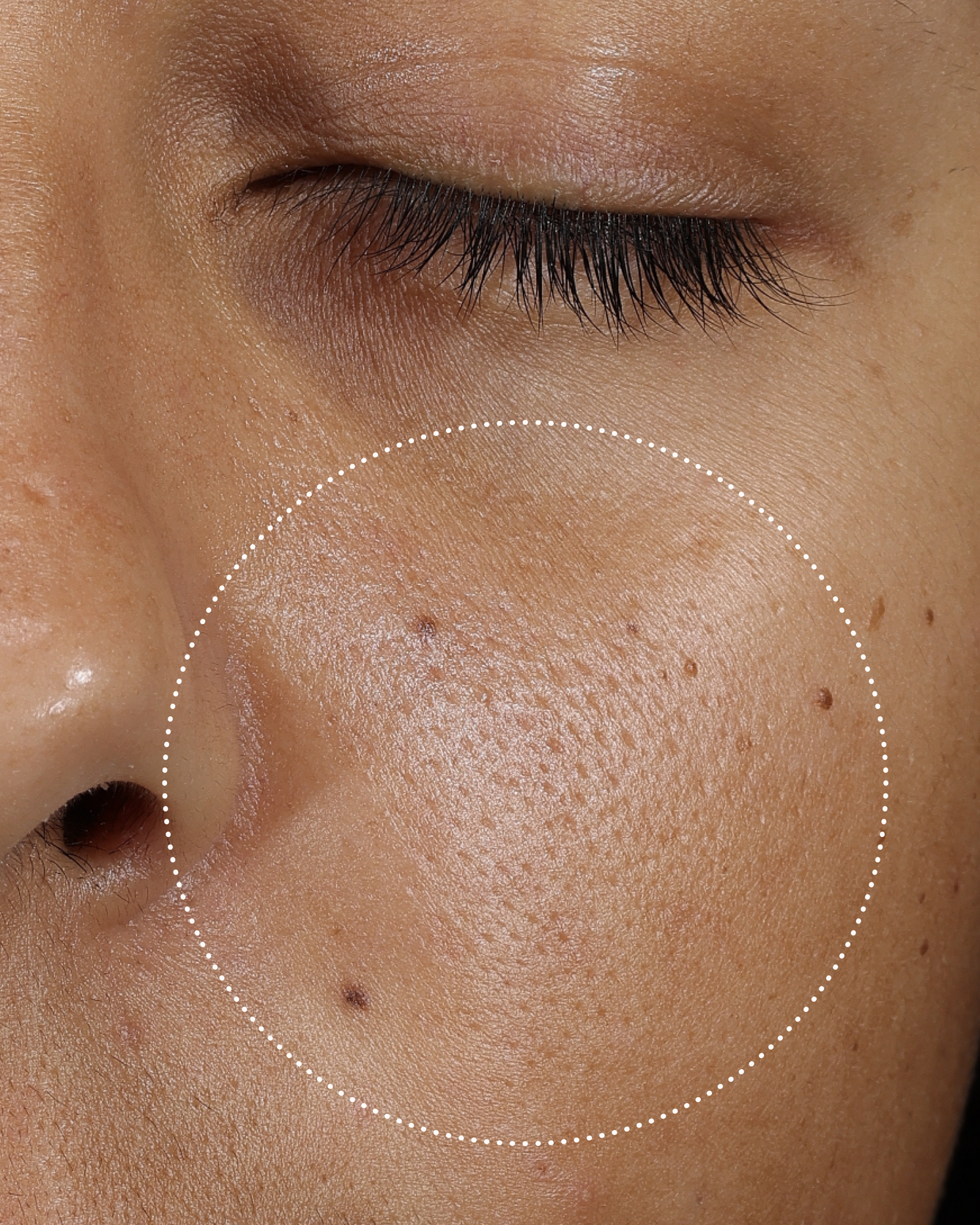 Clinical before photo showing cheek skin with visible pores and uneven texture, with a dotted circle highlighting the treatment area.