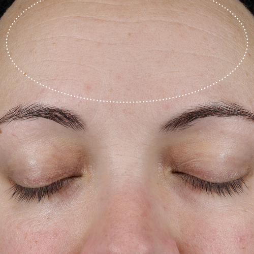 Clinical after photo showing visibly smoother, more even forehead skin following use of Skinfix Ceramide Prime Whipped Cream, with a dotted oval highlighting the treatment area.