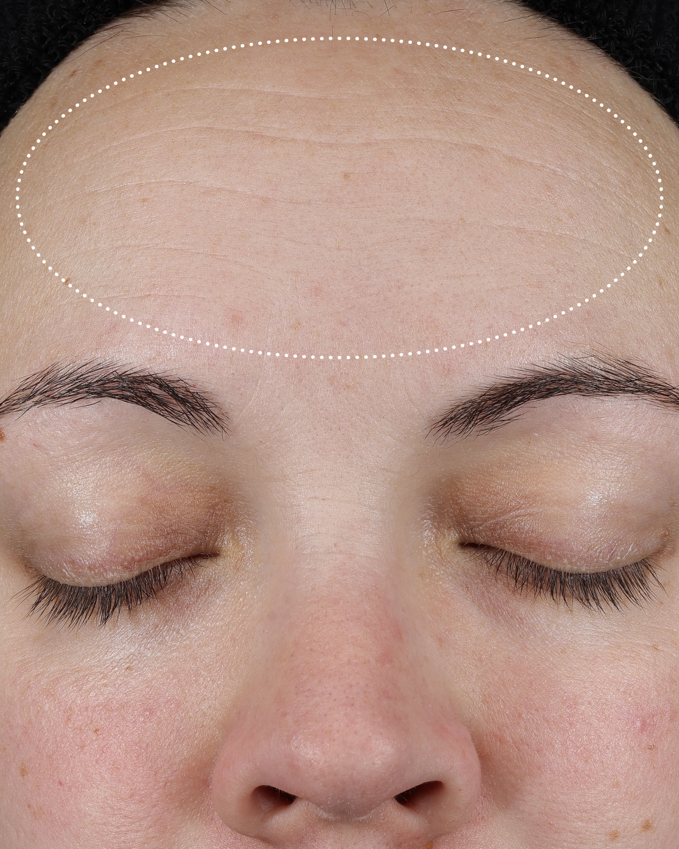 Clinical after photo showing visibly smoother, more even forehead skin following use of Skinfix Ceramide Prime Whipped Cream, with a dotted oval highlighting the treatment area.