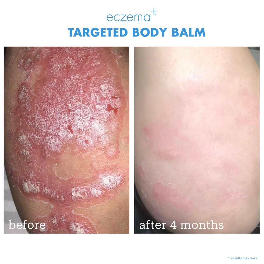 Eczema+ Targeted Body Balm before & after 