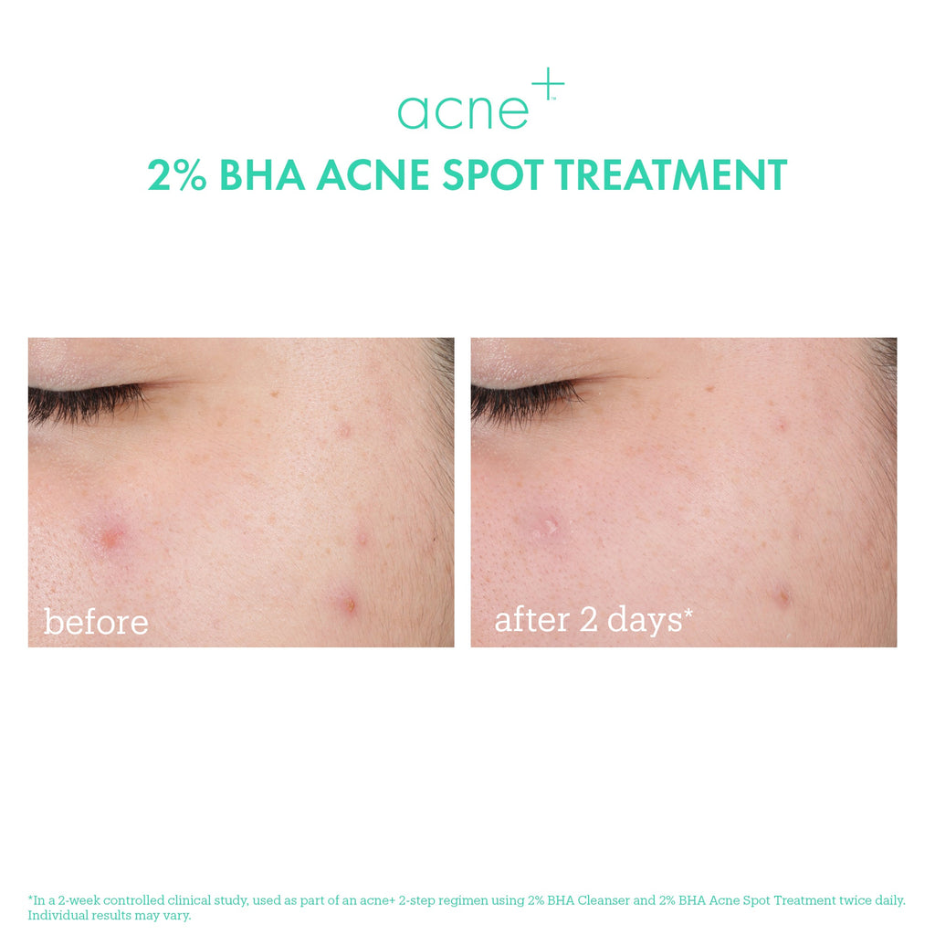 Acne+ 2% BHA Acne Spot Treatment before & after 1