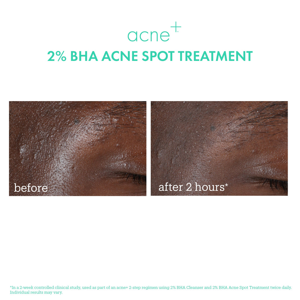 Acne+ 2% BHA Acne Spot Treatment before & after 2
