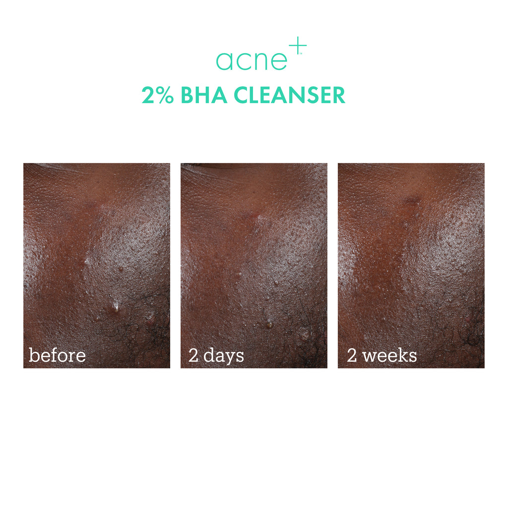 acne+ 2% BHA cleanser before + after